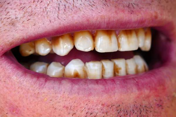 dientes con manchas