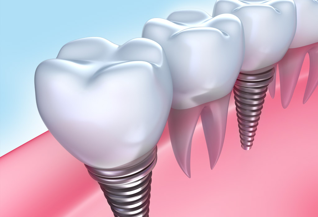 implantes dentales Barberà